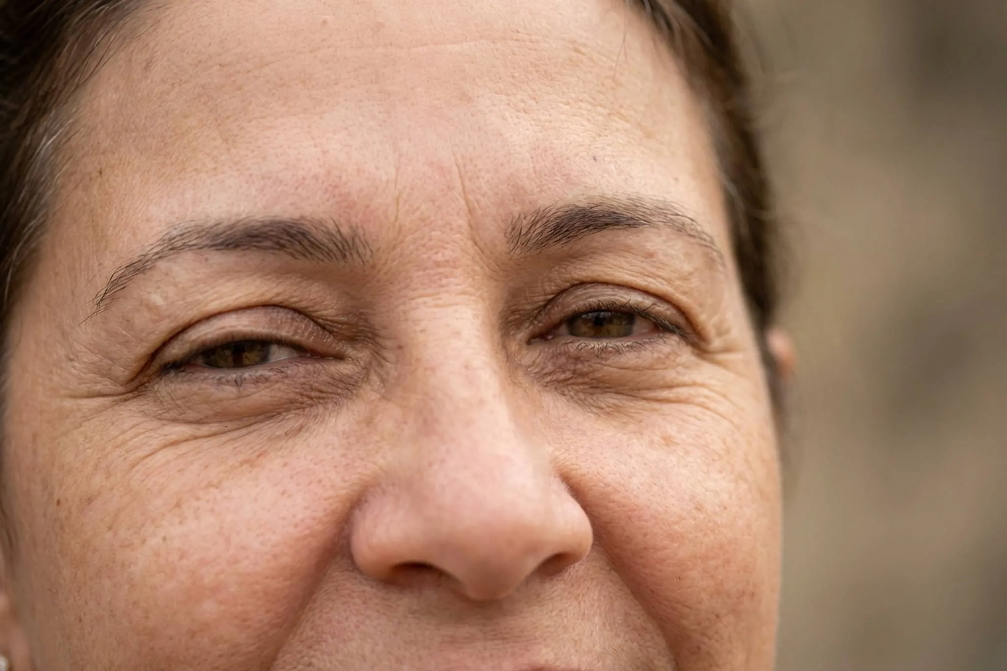 Ptose Palpebral em Londrina